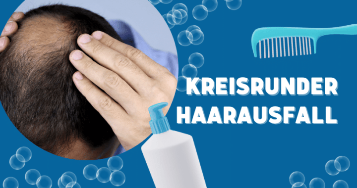 Kreisrunder Haarausfall Beitragsbild