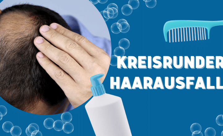 Kreisrunder Haarausfall Beitragsbild